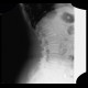 Aneurysm of abdominal aorta on plain radiograph, stent: X-ray - Plain radiograph